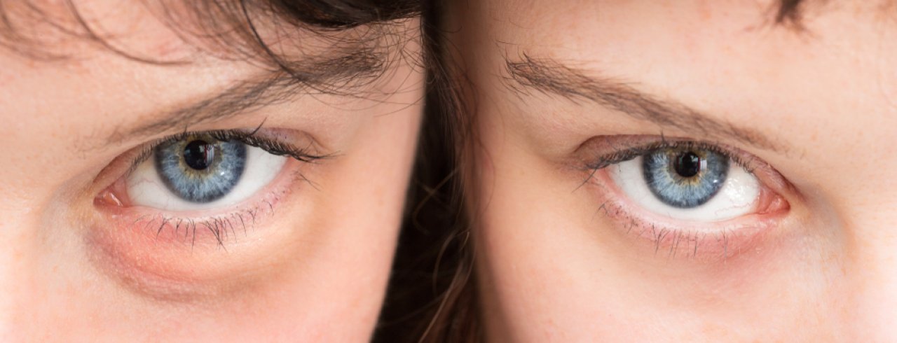 ameliyatsiz-goz-kapagi-estetigi