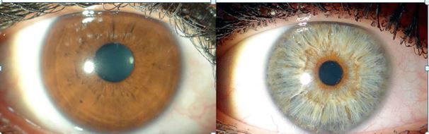 göz rengi değiştirme